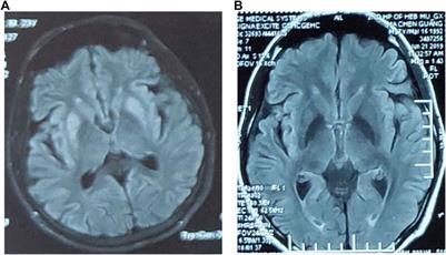 Case Report: Novel Mutations in the PCCB Gene Causing Late-Onset Propionic Acidemia